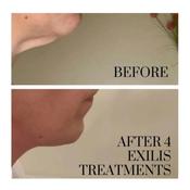 Exilis ultra 360