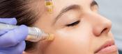 Micro Needling With Exosomes