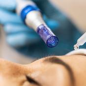 Microneedling with Exosomes