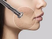 Microdermabrasion ABT Certificate