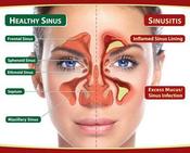 Holistic Sinus and Nasal treatment image