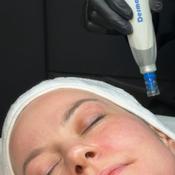 Dermapen™ Microneedling