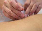 €29 Introduction to Acupuncture Course