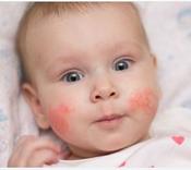 €29 Eczema Awareness Diploma Course Online