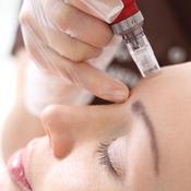 Microneedling - Course of 4 treatments