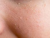 Milia Removal — 4 or more (30 minutes)