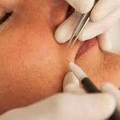 Apilus (small area) - Course of 6 treatments