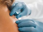 Skin Tag Removal — 4 or more (30 minutes)