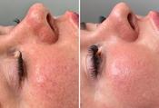 Thread Vein Removal — Full Face - Course of 3 treatments