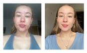 Clear Skin Transformation Programme