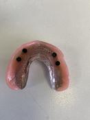 Clicktite Overdentures