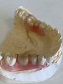 Vallpast Flexi dentures - Removable bridges image