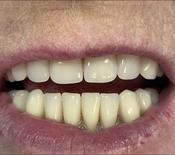 Cosmetic Dentures image